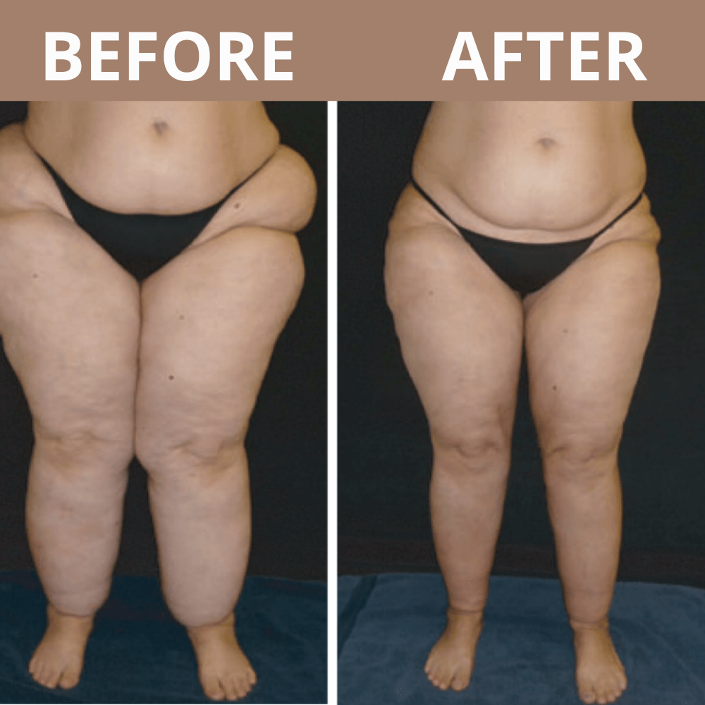 Elivara™ Lipedema Leggings